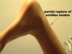 Swollen achilles clearance tendon lump